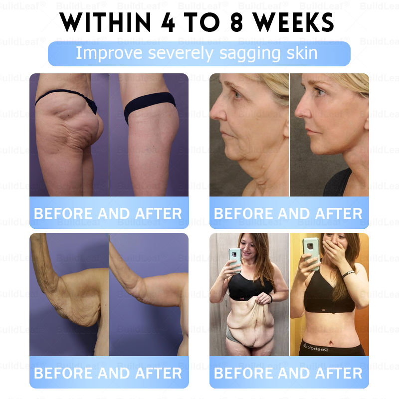 FDA Store·💎💎💎𝐁𝐮𝐢𝐥𝗱𝐋𝐞𝐚𝐟®𝐒𝐥𝐢𝐦 & 𝐅𝐢𝐫𝐦 𝐍𝐚𝐧𝐨 𝐌𝐢𝐜𝐫𝐨𝐧𝐞𝐞𝐝𝐥𝐞 𝐏𝐚𝐭𝐜𝐡 𝐰𝐢𝐭𝐡 𝐌𝐨𝐫𝐢𝐧𝐠𝐚, 𝐎𝐦𝐞𝐠𝐚-𝟑, 𝐂𝐨𝐥𝐥𝐚𝐠𝐞𝐧 𝐏𝐞𝐩𝐭𝐢𝐝𝐞𝐬, 𝐍𝐀𝐃 & 𝐍𝐌𝐍 𝐟𝐨𝐫 𝐎𝐛𝐞𝐬𝐢𝐭𝐲, 𝐂𝐚𝐫𝐝𝐢𝐨𝐯𝐚𝐬𝐜𝐮𝐥𝐚𝐫 𝐃𝐢𝐬𝐞𝐚𝐬𝐞, 𝐃𝐢𝐚𝐛𝐞𝐭𝐞𝐬, 𝐒𝐥𝐞𝐞𝐩 𝐀𝐩𝐧𝐞𝐚, 𝐉𝐨𝐢𝐧𝐭 𝐏𝐫𝐨𝐛𝐥𝐞𝐦𝐬, 𝐒𝐤𝐢𝐧 𝐅𝐢𝐫𝐦𝐢𝐧𝐠, 𝐀𝐧𝐭𝐢-𝐀𝐠𝐢𝐧𝐠, 𝐚𝐧𝐝 𝐌𝐨𝐫𝐞